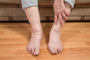 Geriatric foot care in the Cuyahoga County, OH: Parma (Middleburg Heights, Brooklyn, Berea, Broadview Heights, Independence, Strongsville, Fairview Park, Lakewood, North Olmsted, Linndale, North Royalton), Cleveland (Garfield Heights, Maple Heights, Seven Hills, Shaker Heights, Bedford, Warrensville Heights, Euclid, Bratenahl, University Heights), Westlake (Rocky River, Bay Village, Olmsted Falls, Brook Park) and Lorain County, OH: Sheffield Lake, Avon, North Ridgeville areas